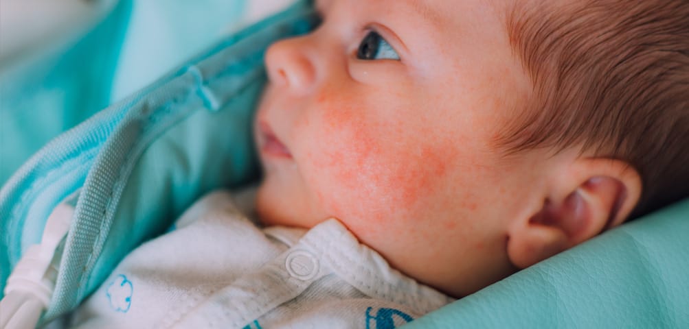 Atopijski dermatitis kod beba i dece