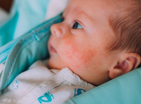 Atopijski dermatitis kod beba i dece