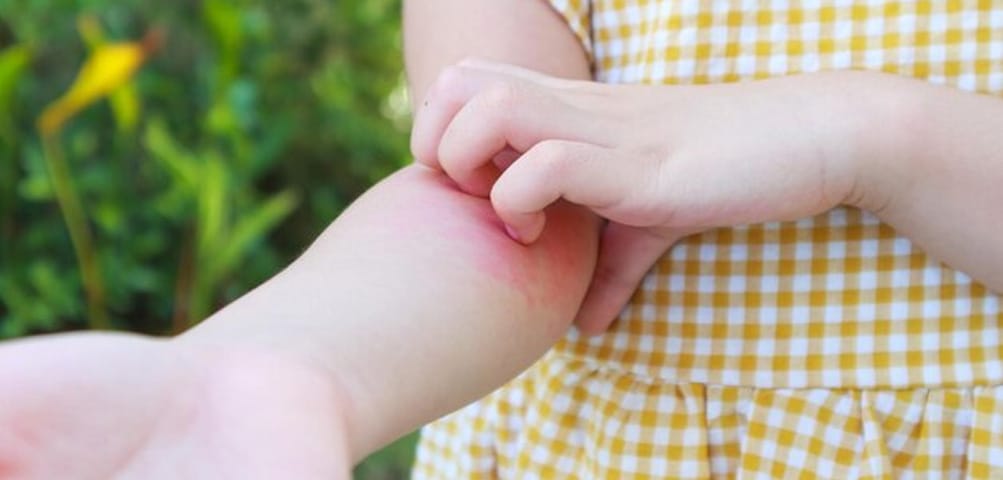 Prirodni lek za ekcem kod dece