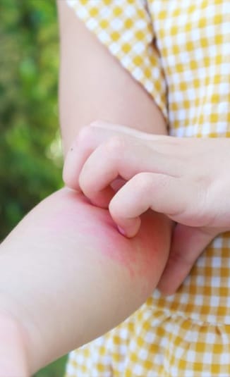 Najbolja krema za ekcem (atopijski dermatitis)