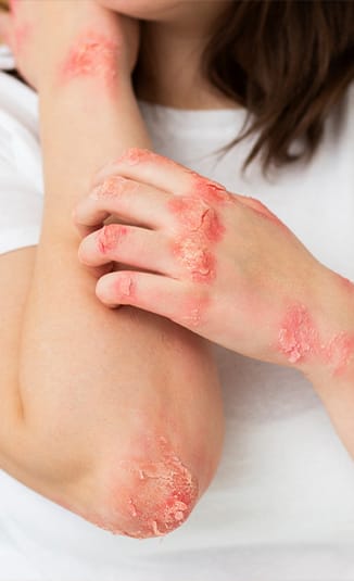 Atopijski dermatitis: sve što treba da znate o ovom stanju?